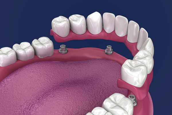 3D rendering of overdentures in a mouth 3D rendering of overdentures in a mouth