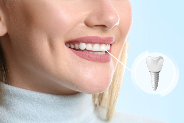 Woman showing her dental implant